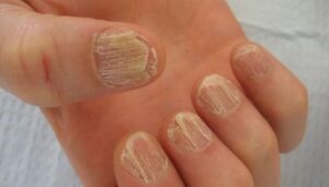 جدا شدن ناخن از بستر